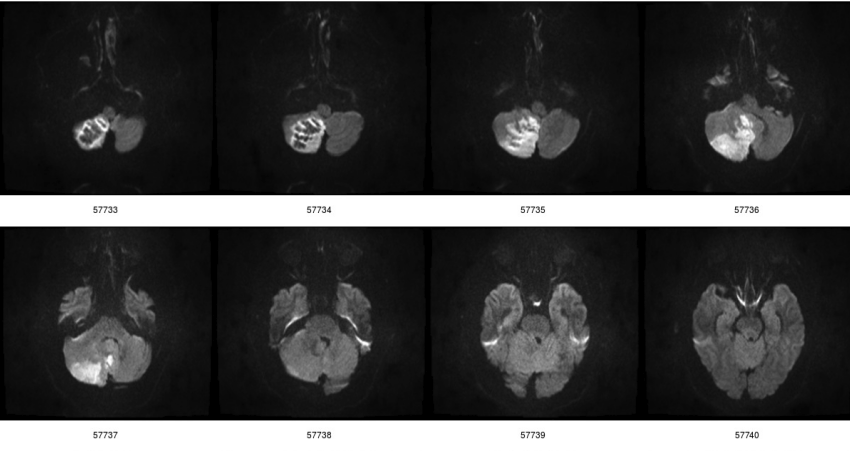 cerebellar diffusion images