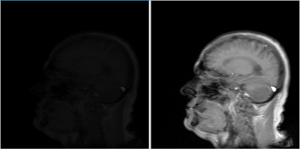 Dicom image before and after normalize