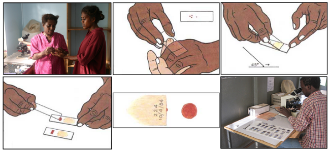 Blood smear workflow for Malaria detection